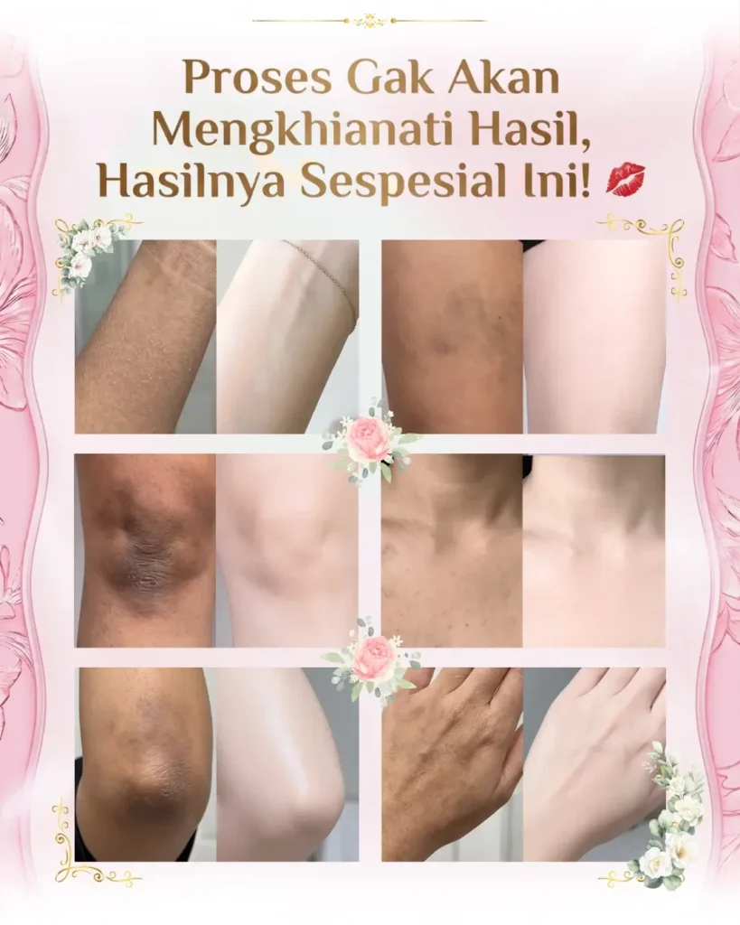 Perbandingan kulit sebelum dan sesudah menggunakan RitzGlam: Solusi efektif untuk kulit gelap, bersisik, kusam, dan warna tidak merata.