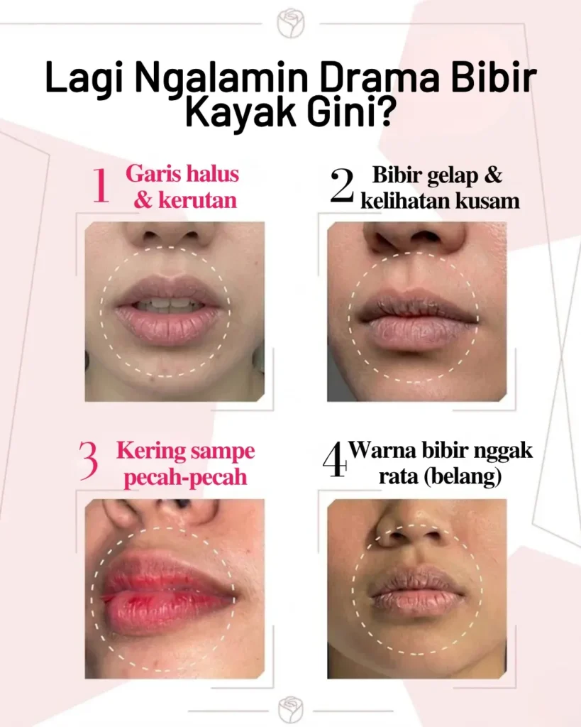 Masalah drama bibir seperti garis halus, bibir gelap kusam, kering pecah-pecah, dan warna bibir tidak rata atau belang.